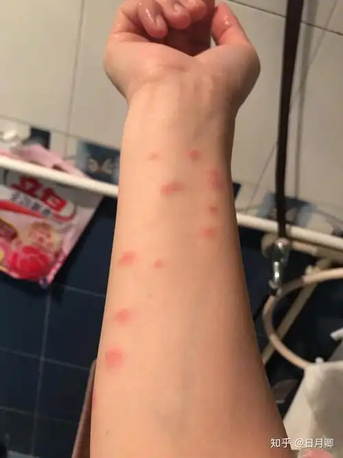 被跳蚤咬的全身都是包是什么样的感受! - 知乎