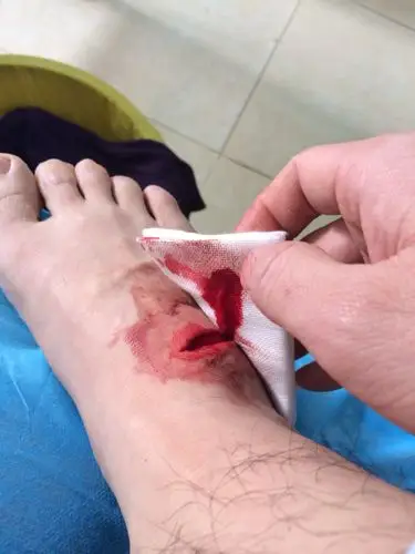 脚筋断了.公司要怎么处理