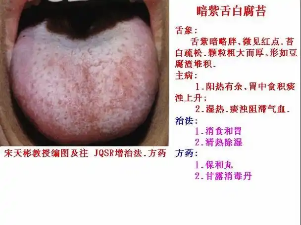 【转载】舌象图解及疗法—— 2