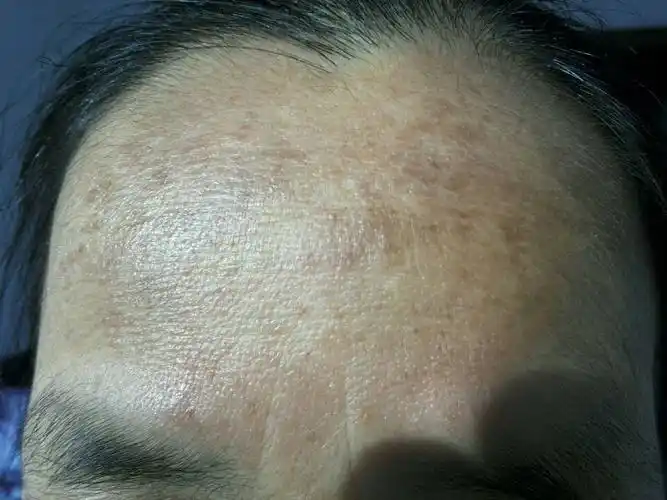 大概一个月前,一天晚上我妈突然发现额头有黑印,以前没注意到.