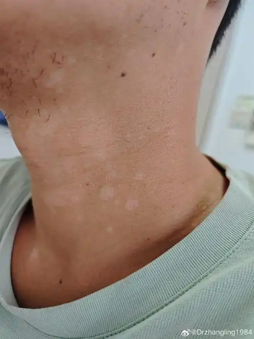 白斑##白癜风##单纯糠疹##健康小知识