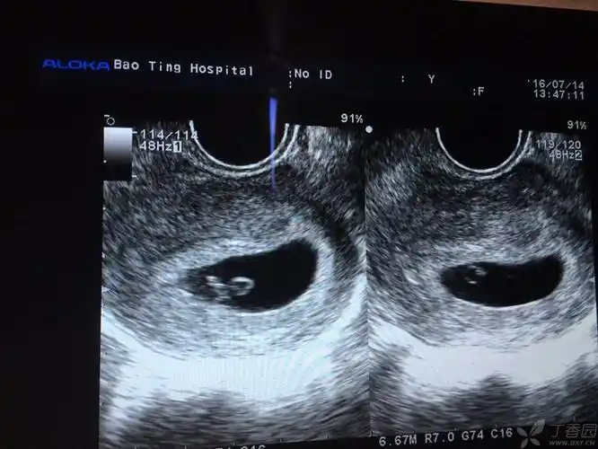是否可以诊断早期双胎? [病例帖]