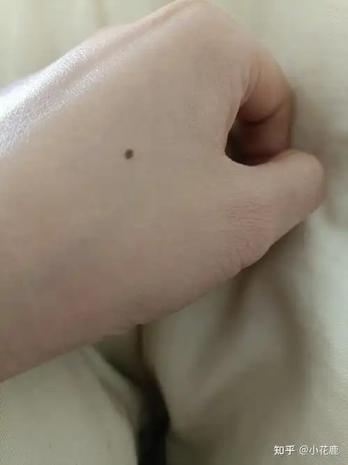 虎口上有痣的人会怎么样