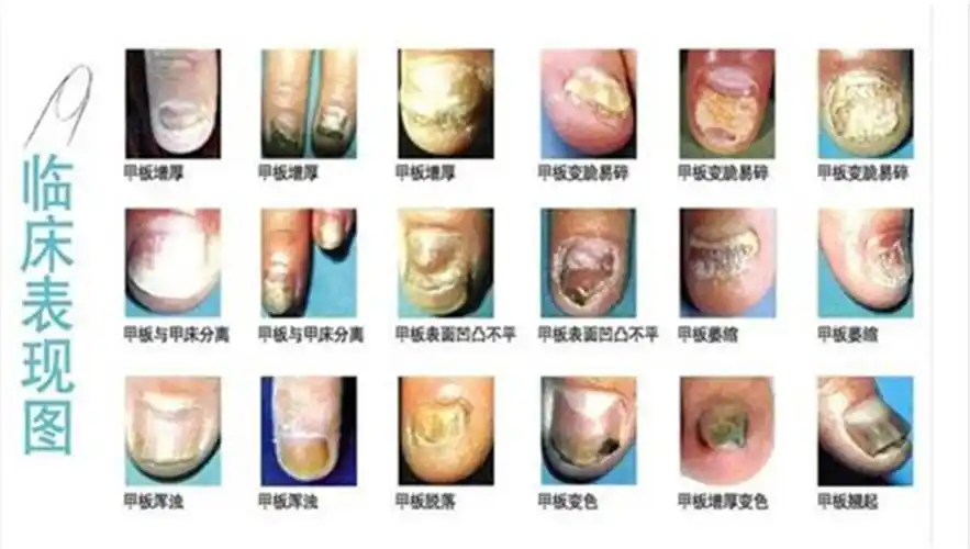 灰指甲初期图片脚趾头