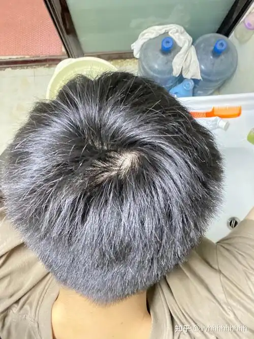 什么样子的发旋是正常的啊