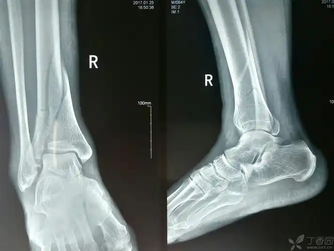 胫腓骨远端骨折