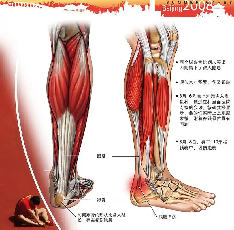 炎症性疼痛: 各种原因导致的腓肠肌筋膜炎后,出现腓肠肌压痛.