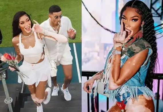 恩爱奶牛超模陪库兹马庆27岁生日腹部大片白斑似病情加重