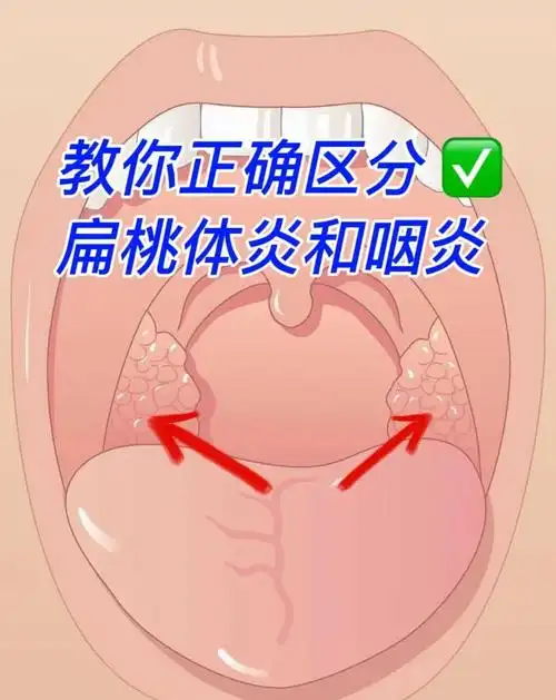 咽痛高发季,分清咽炎or扁桃体炎💊