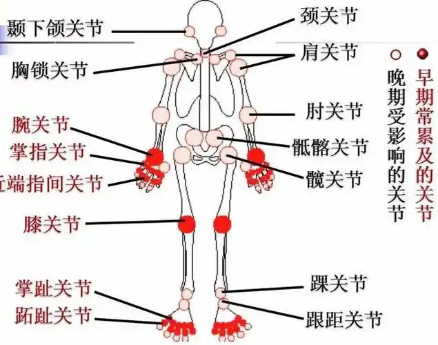 市立晨课 | 看懂这些 才真正认识类风湿关节炎