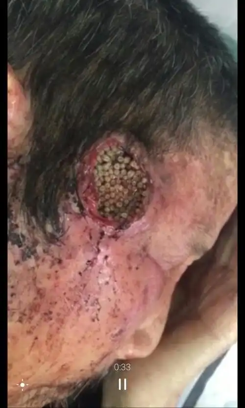 我看了一个视频,就是一个老人太阳穴里都是虫子