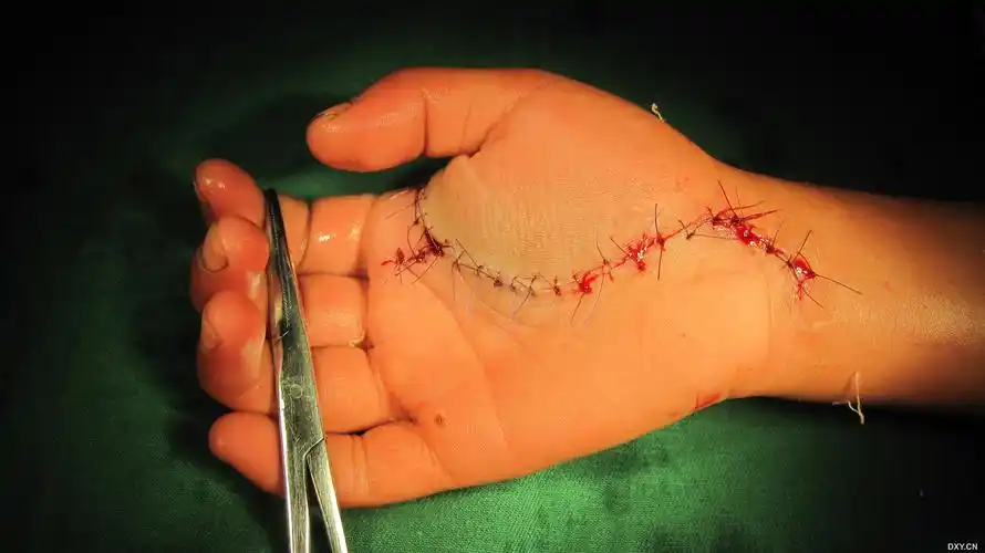 【病例讨论】儿童手掌海绵状血管瘤一例