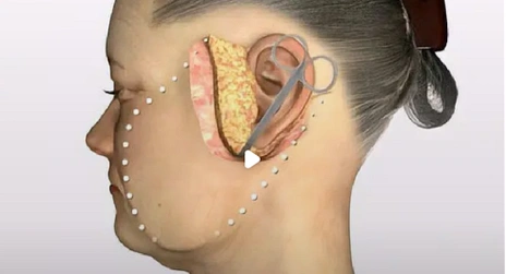 深扒smas筋膜悬吊术的原理?额肌悬吊术能维持多久?早知道!