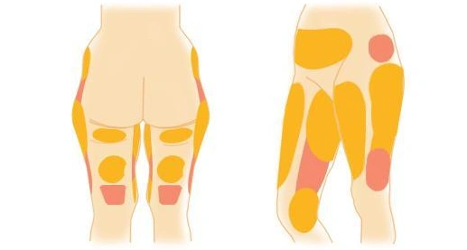 女人的脂肪主要分布在皮下,特别是四肢,屁股,大腿等部位,也就是说即使
