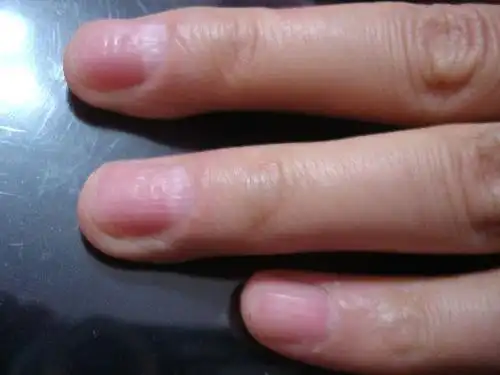 人体出现这样的指甲,要当心身体病变