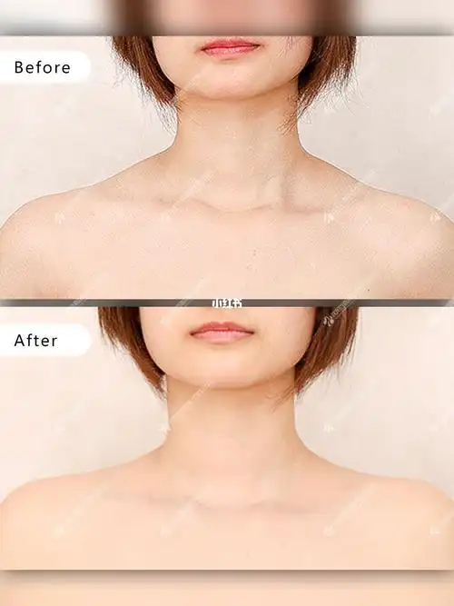 小露香肩的秘密武器瘦肩针