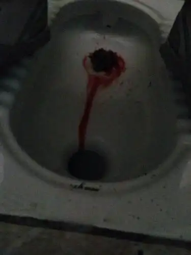 请问这是属于什么情况?本人女的,没来大姨妈,大便时出现大量出血