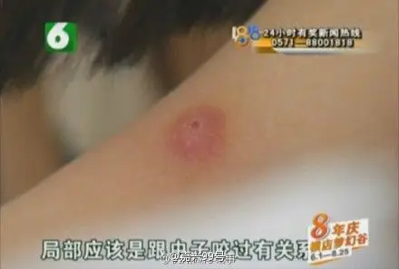 杭州姑娘非洲旅游回来身上寄生了皮肤蝇幼虫
