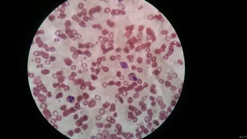 学涂片请教下面血涂片有原始细胞吗