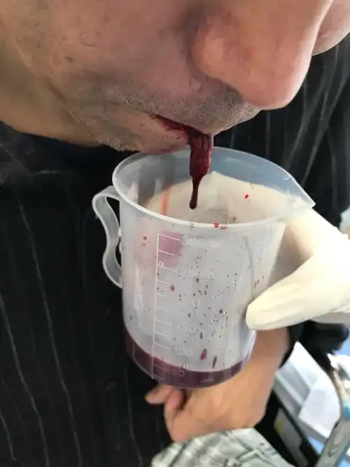 藏医外治法之藏医放血疗法