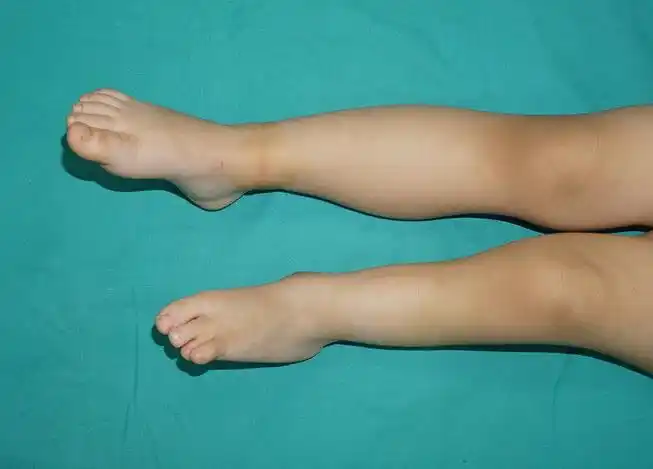 先天性腓骨缺如或发育不全的孩子到底怎么治