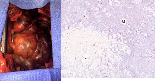 pleural lipoma clinically mimicking the presentation of