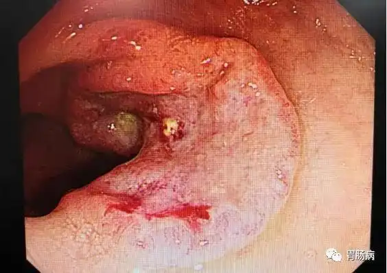 "假出血"查出来真肠癌!