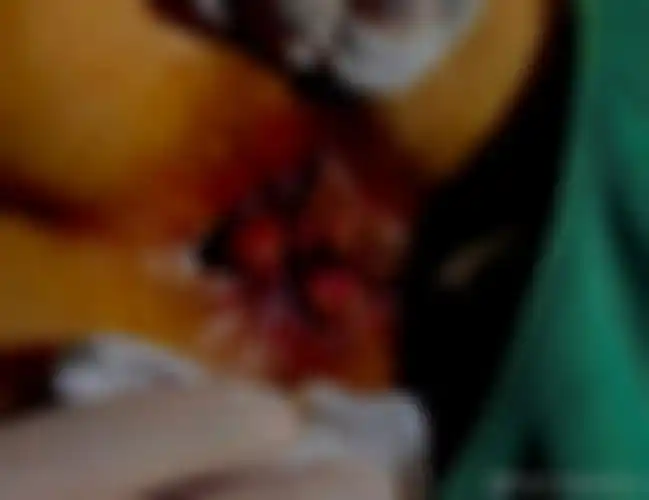 肛肠外科手术视频:混合痔肛裂保留齿线组合术式(20240502)