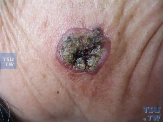 恶性肿瘤:鳞癌的症状表现〔慎入〕 - 皮肤病学 - 天山医学院