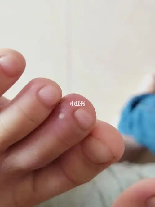 小奶娃被蚂蚁咬伤了,涂了金霉素眼药膏好多了.蚂蚁有毒,可怜的娃娃