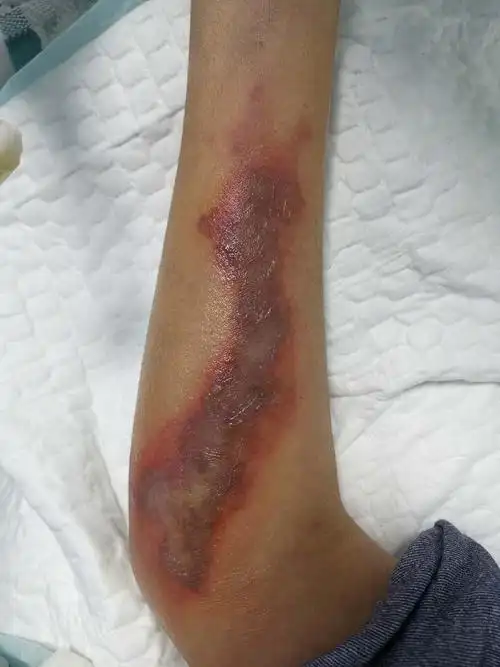 一例药物外渗经过