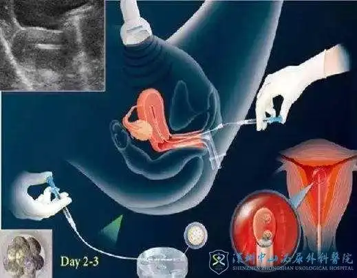 试管一般移植几个胚胎囊胚一次可以移植几个