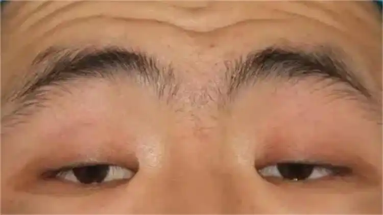 双眼皮提肌不要乱做!医生教你2招判断是不是提肌无力!