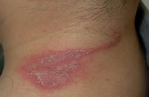 囊虫皮炎症状图片