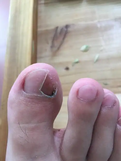 跑步使脚趾甲变空变成绿色是灰指甲吗?