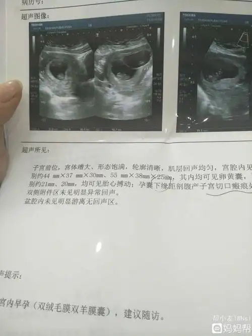 据统计,生一千对双胞胎,可产生一对龙凤胎而有生双胞胎家族史的人生