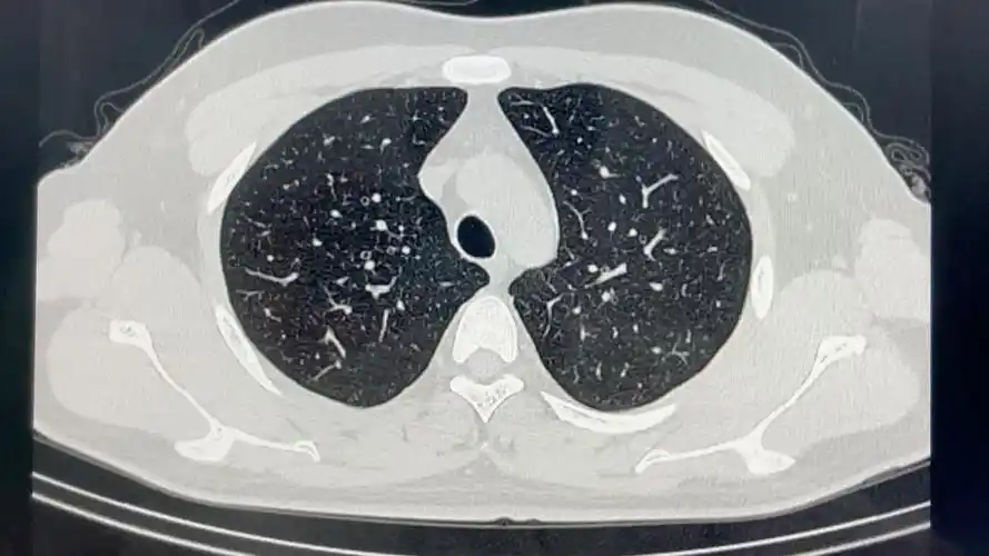 正常胸部ct的肺窗影像