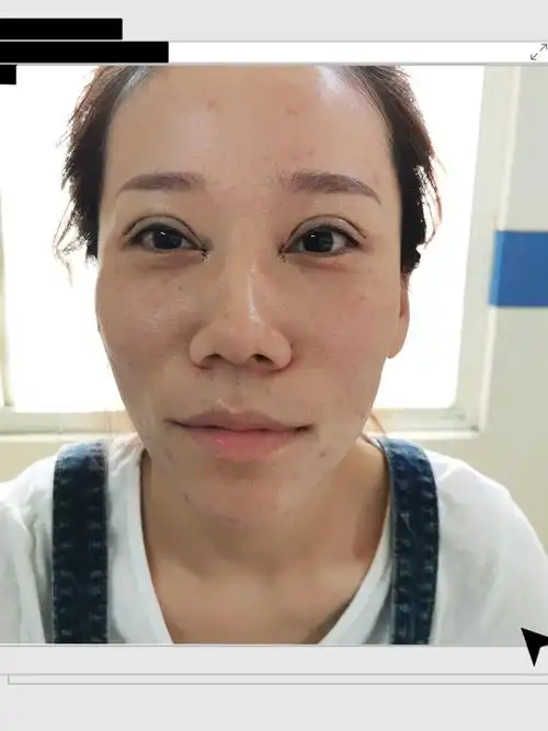 患者是内双眼睑下垂松弛采用全切加开眼角手术过程顺利_圈子-新氧美容