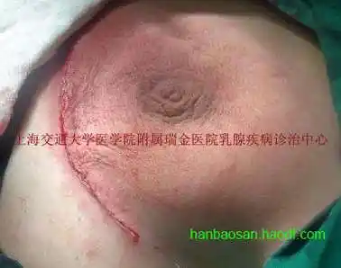 乳腺良性肿瘤:触目惊心的乳腺巨大纤维瘤!附图片
