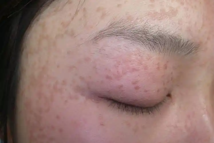 扁平疣症状特点有哪些