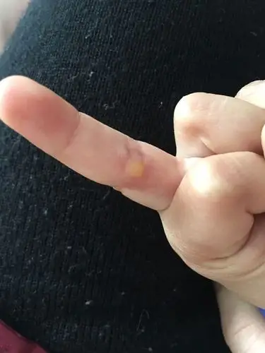 手指关节处长了个硬疙瘩