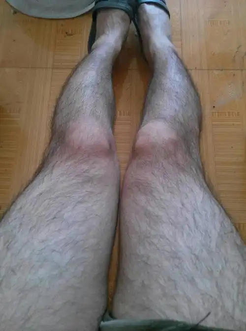 我的腿上长这么多汗毛是什么原因导致的?