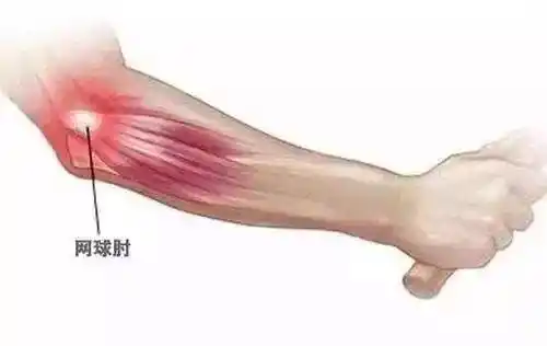 手肘疼痛不能握物抬不起来用力就疼痛怎么办中医针灸治疗网球肘