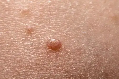 身上长这3种小疙瘩的说明已感染了hpv快看你有没有