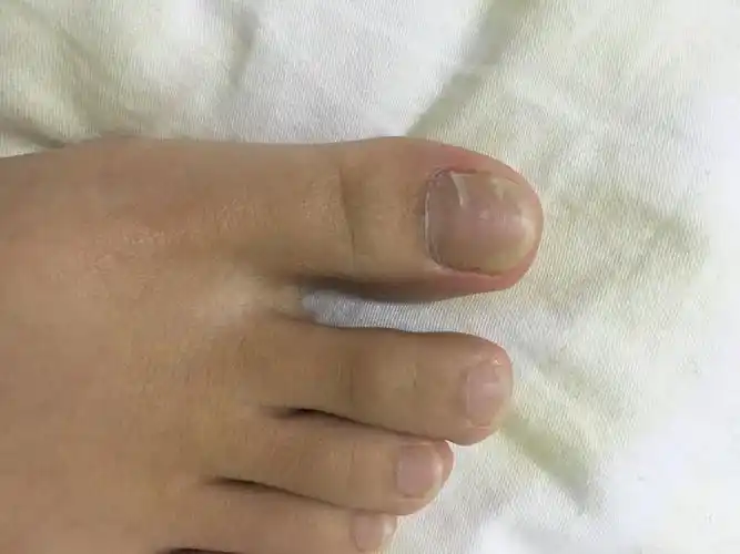 两个大脚趾都变成这样了,不平有横纹,边上指甲有点空,最近还出现裂痕