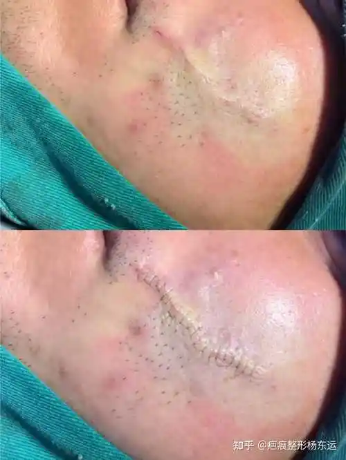 疤痕整形杨东运 的想法: 徒弟汤医生的缝合水平已经到了这个境界