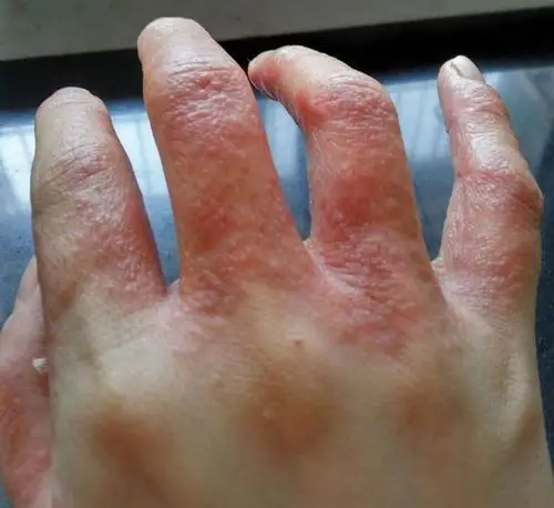 每年夏天手指长水泡又特别痒八成是汗疱疹来袭