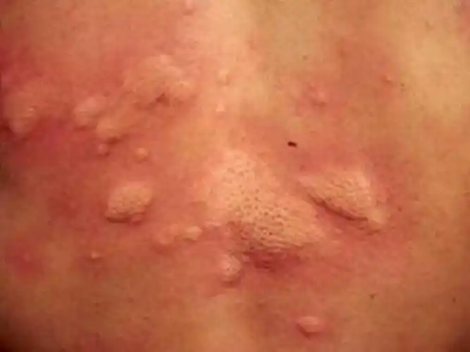 寒冷性荨麻疹手背皮肤病图片