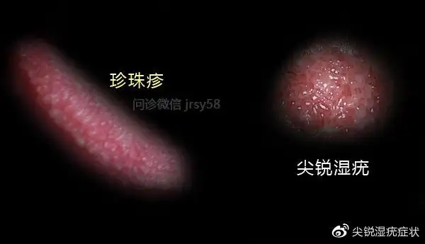 尖锐湿疣怎么鉴定假性