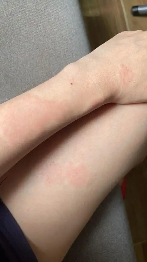 怀孕三个多月,身上长了一片片红的,会痒.这是什么呀,能用药吗